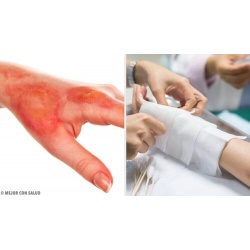 Κρέμες και Περιποίηση Εγκαυμάτων